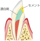歯のきばみ着色の治療　漂白
