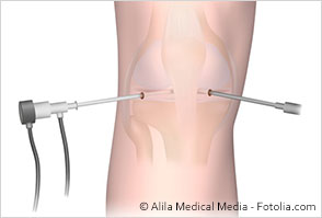 Schematische Darstellung Arthroskopie am Knie