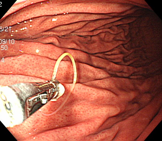 胃アニサキスを内視鏡的に摘除