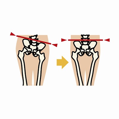 骨盤の歪みのイメージ画像