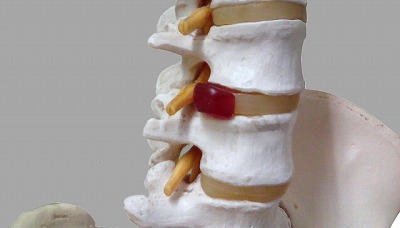 椎間板から突出した腰椎のヘルニア(赤い部分)