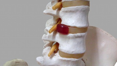 椎間板から突出した腰椎のヘルニア（赤い部分）