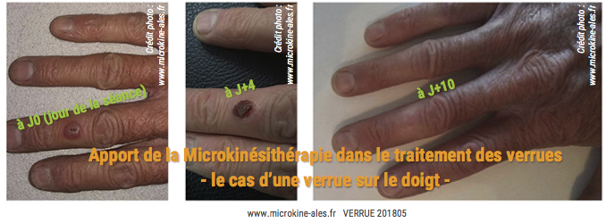 Verrues Microkinésithérapie Traitement