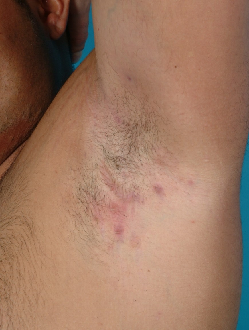 L' idrosadenite suppurativa (HS) o Acne inversa? Perché usare il Macrogel-Gel cosmetico della ditta CercoSano quando si ha l'idrosadenite suppurativa (HS) o acn