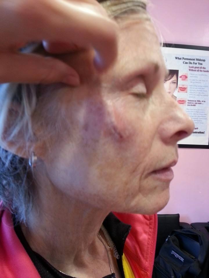 Laser Tattoo Removal - VORTEX Advanced Esthetics &amp; SPA massage