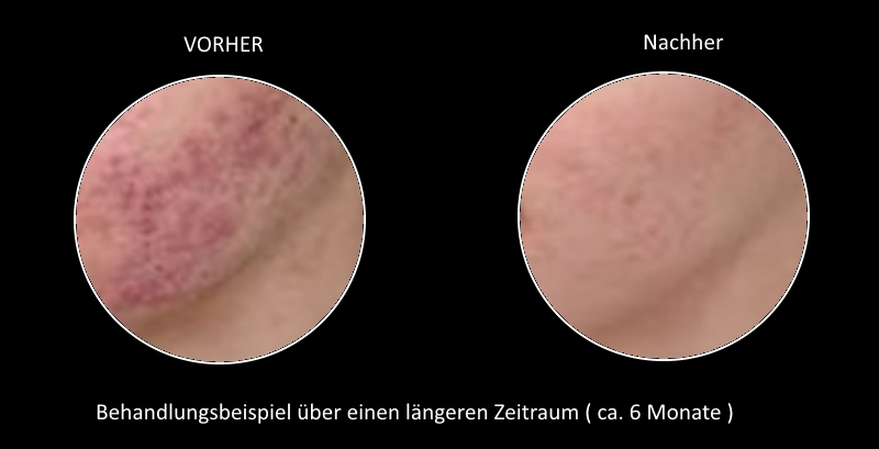 Glättung von Aknenarben