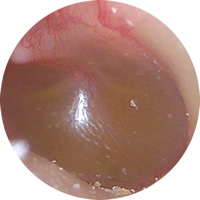 大阪府　堺市　耳鼻科　耳鼻咽喉科　しまだ耳鼻咽喉科　急性中耳炎　中耳炎　渗出性中耳炎