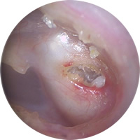 大阪府　堺市　耳鼻科　耳鼻咽喉科　しまだ耳鼻咽喉科　急性中耳炎　中耳炎　真珠腫性中耳炎