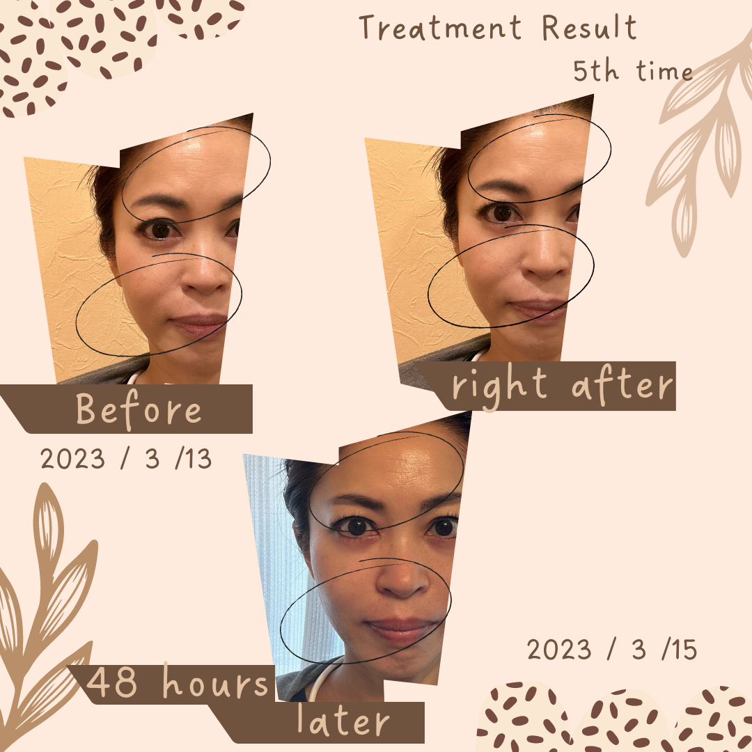 3月美容鍼の経過