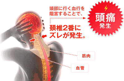 頸椎2番にズレが発生。頭部に行く血行を阻害することで、頭痛が発生。筋肉、血管