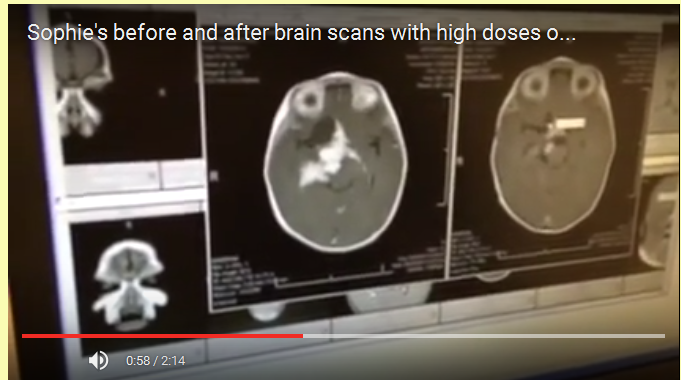 scans avant et apres traitement avec du cannabis