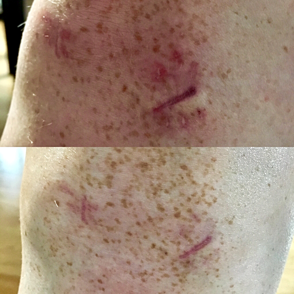 Meine Narben am Knie, oben am 22.09.17 und unten am 22.10.17