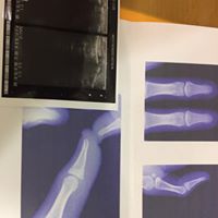 骨折していても意外と動ける？その真実を解説