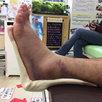 骨折用超音波治療器LIPUSについて：その効果と利用法