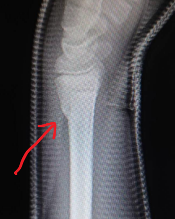 左手首　橈骨遠位端骨折の症例