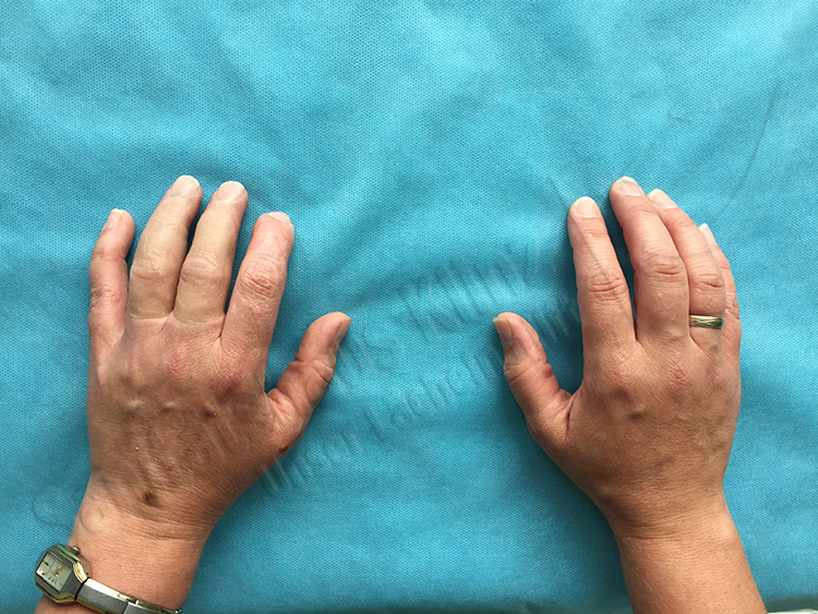Ringfingerprothese Mittelfingerprothese Fingerprothese Silikonprothese Silikon Prothese kosmetischer Ausgleich Amputation Unfall Sanitätshaus Klinz Bernburg