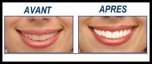 blanchiment des dents toulouse prix blanchiment des dents toulouse prix