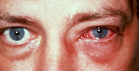 Irritación en los ojos