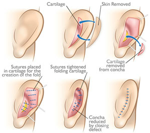 Otoplasty (Ear Pinning Surgery) - Design Cosmetic