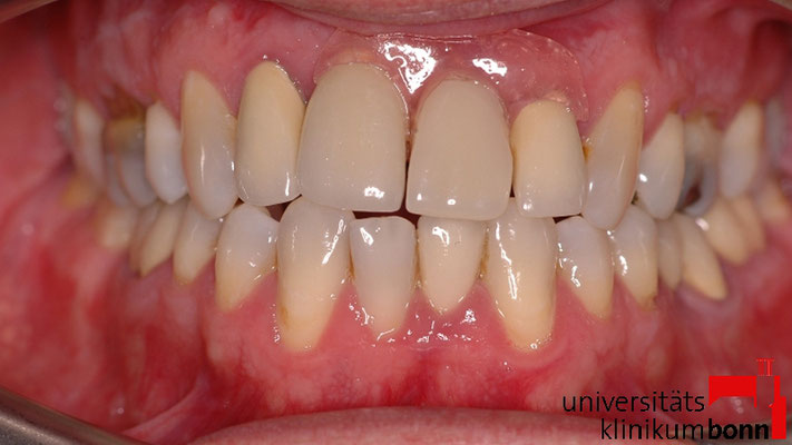 Valplast Superhero Zahnersatz Sauerhoff Schuler Dental Technik Gmbh Zahntechnik In Dusseldorf