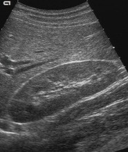 Niere im Ultraschallbild