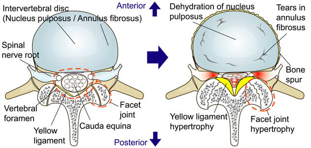 Lumbar Spinal Canal Stenosis