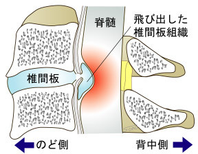 頚椎椎間板ヘルニア