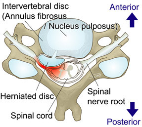 Cervical disc herniation