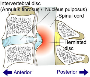 Cervical disc herniation