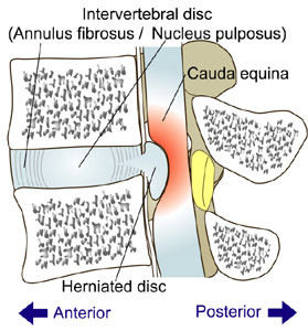 lumbar disc herniation