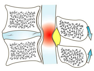 stenosis