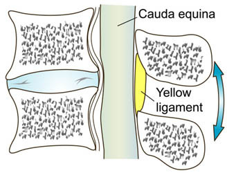 stenosis