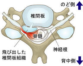 頚椎椎間板ヘルニア