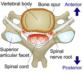 cervical spondylisis