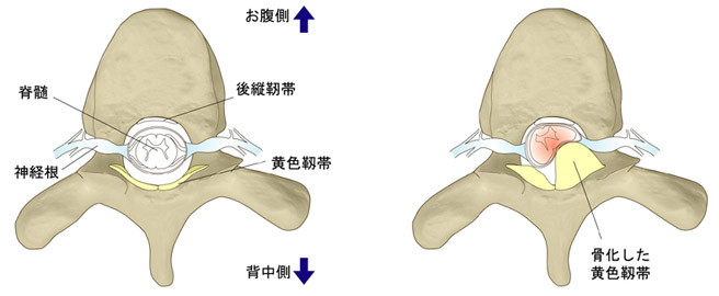 黄色靱帯骨化症