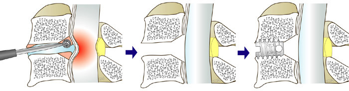 Surgical Treatment