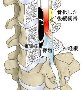 頸椎後縦靭帯骨化症｜診療科のご案内｜洛和会音羽病院（京都市