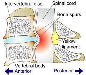 cervical spondylosis