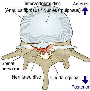 Lumbar disc herniation