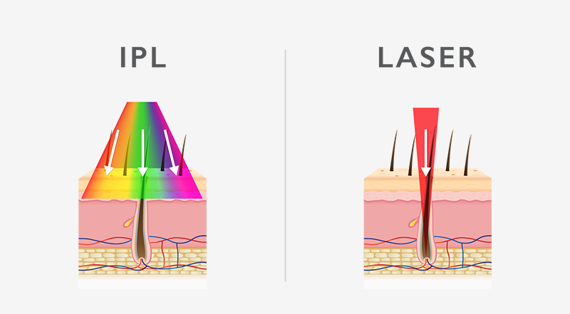 Laser oder IPL Haarentfernung?