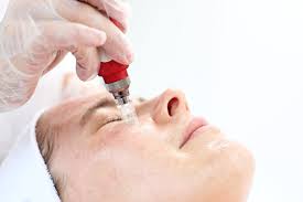 Makellos durch Microneedling