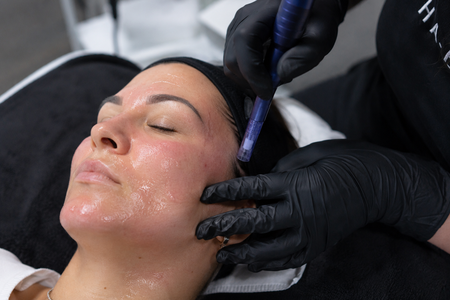 Du wünschst dir ein ebenmäßigeres Hautbild, feinere Poren und mehr Spannkraft? Medical Microneedling zählt zu den effektivsten Methoden der modernen Hautregener
