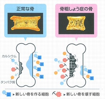 正常な骨と骨粗しょう症の骨