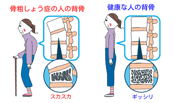 骨粗しょう症の人の背骨と健康な人の背骨