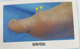 強剛母趾は靴のサイズも原因です らくじき専門店フクワ