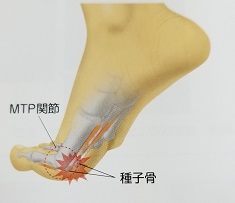 種子骨障害はスポーツなどによる負担大です らくじき専門店フクワ 種子骨障害はスポーツなどによる負担大です らくじき専門店フクワ