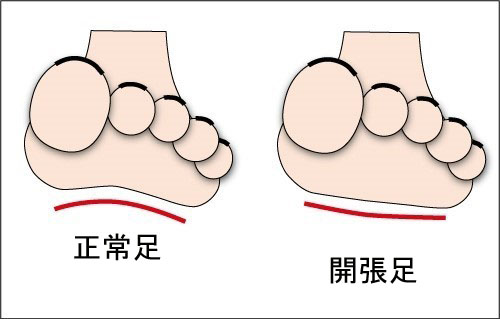 開張足の原因と対策 - 足底筋膜炎・外反母趾・扁平足インソール