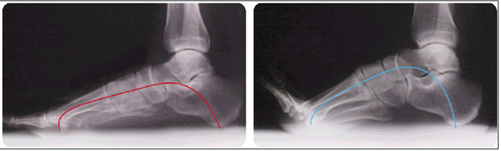 BarefootScienceインソールを使用前後の足骨写真
