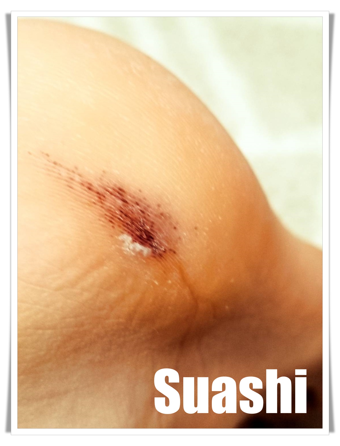 まさか皮膚がん Suashi0210 ページ