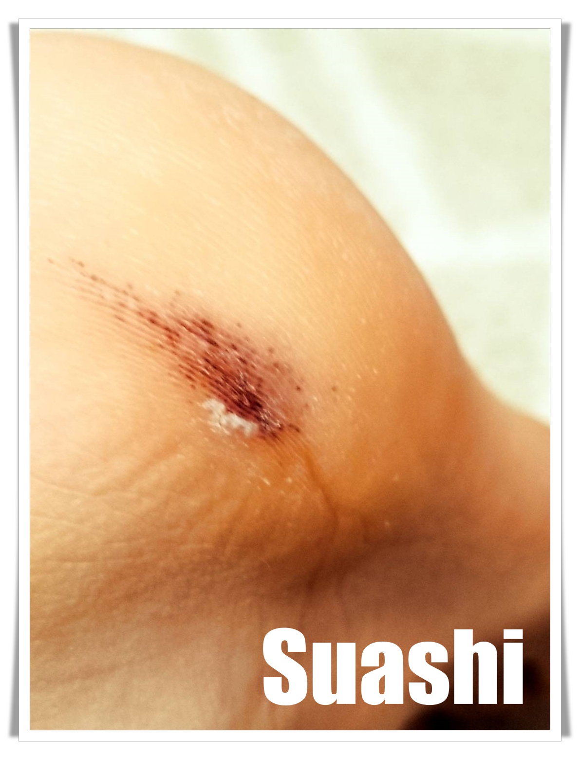 まさか皮膚がん Suashi0210 ページ まさか皮膚がん Suashi0210 ページ